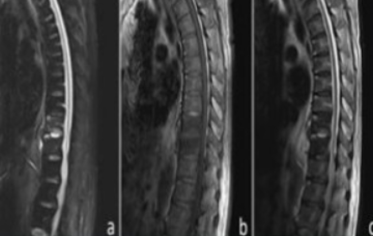 How I do it – tubular trans-spinous process muscle-sparing – tubular trans-spinous process muscle-sparing