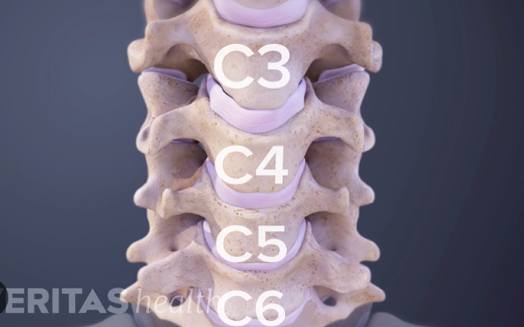 Extreme lateral interbody fusion in spinal revision surgery: clinical clinical clinical clinical